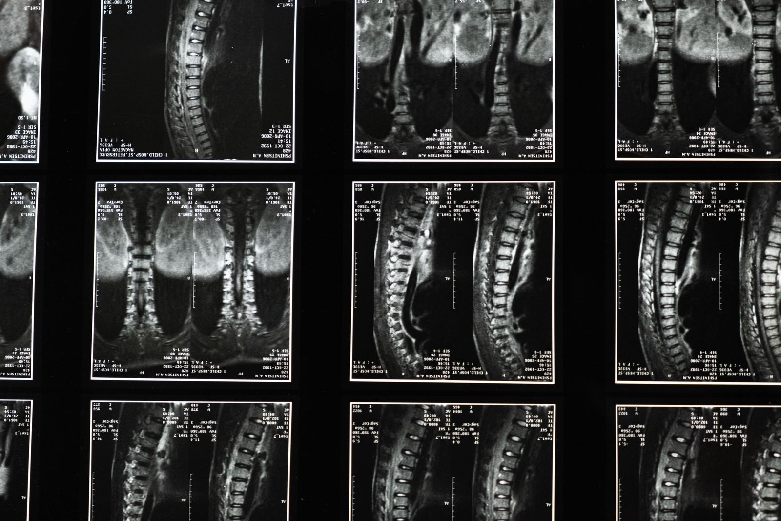 Bel Kanal Darlığı (Spinal Stenoz): Yürürken Neden Bacaklar Ağrır?